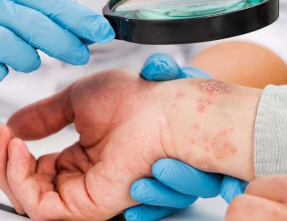 Poli Penyakit Kulit dan Kelamin